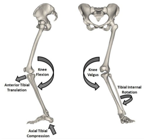 The ACL Injury - RISE Physio & Rehab